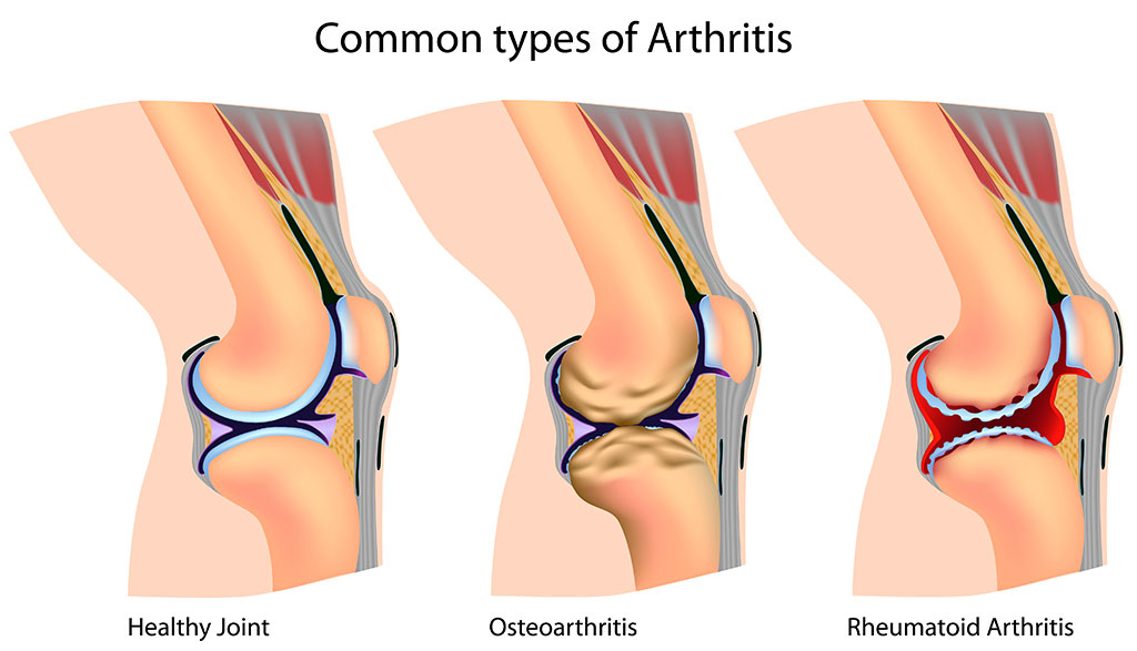 Common types of Arthritis.
